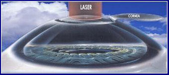 Imagem LASIK